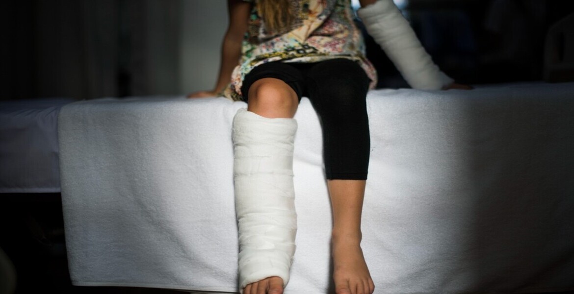 Broken Bones (Fractures)